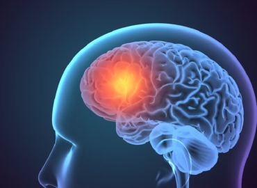Brain Stroke, Stroke Signs and Symptoms